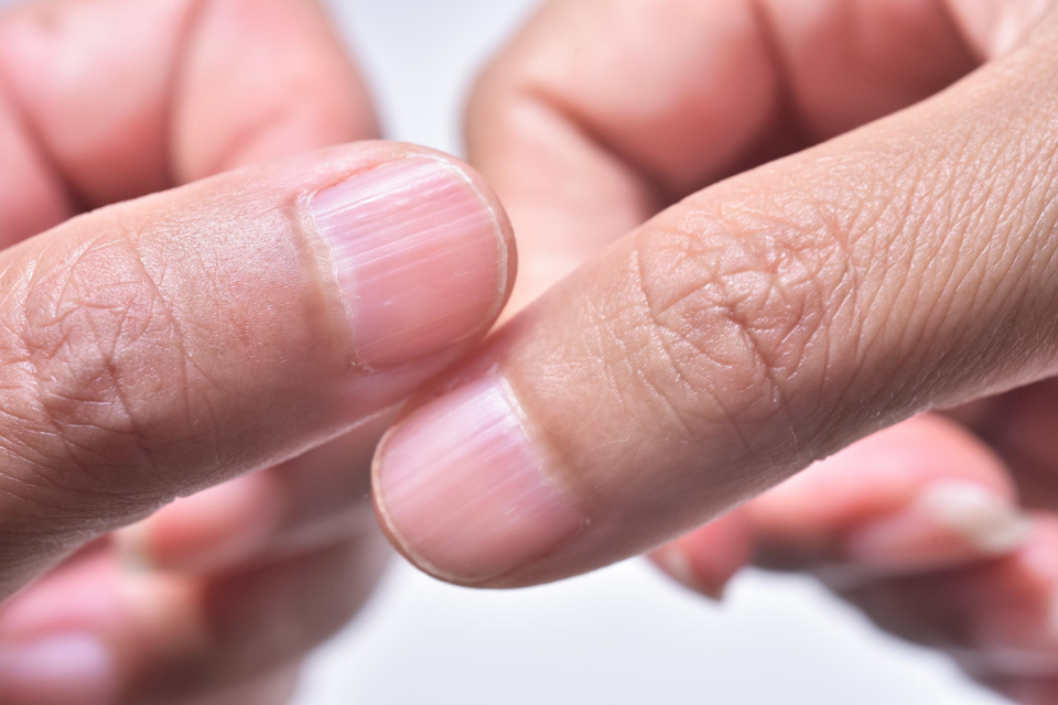 Your nails have deep horizontal ridges