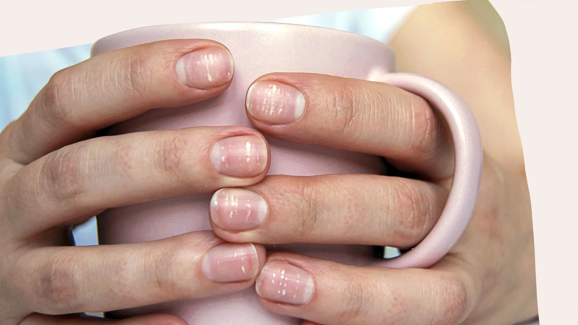 Your nails have white spots