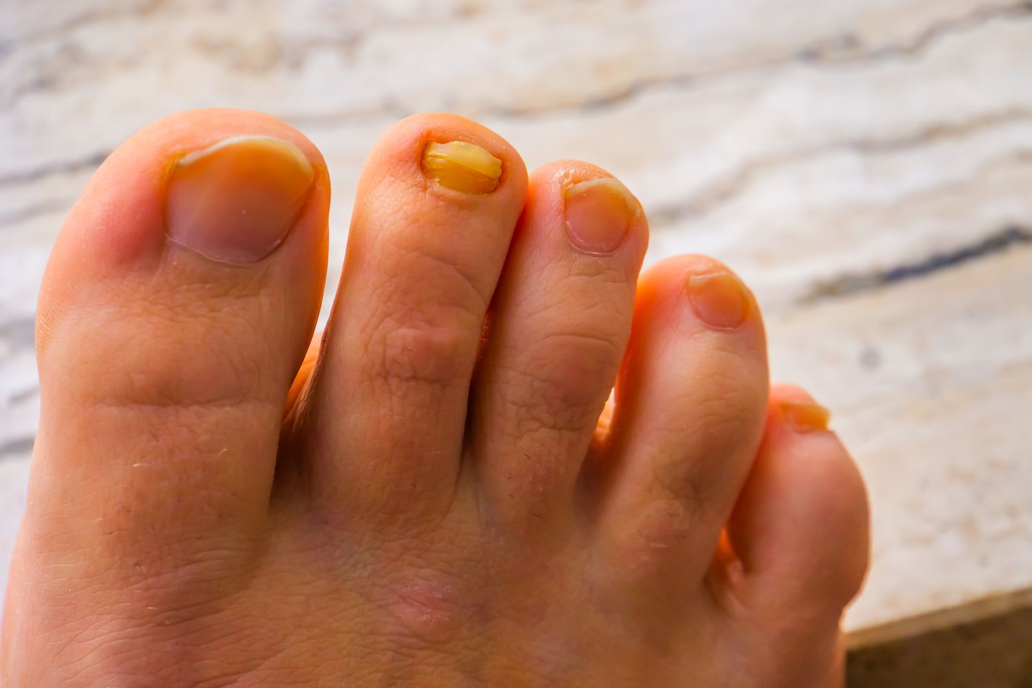 Yellow nail syndrome